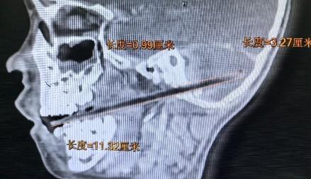 男童口含麦芽糖摔倒被竹签刺入小脑