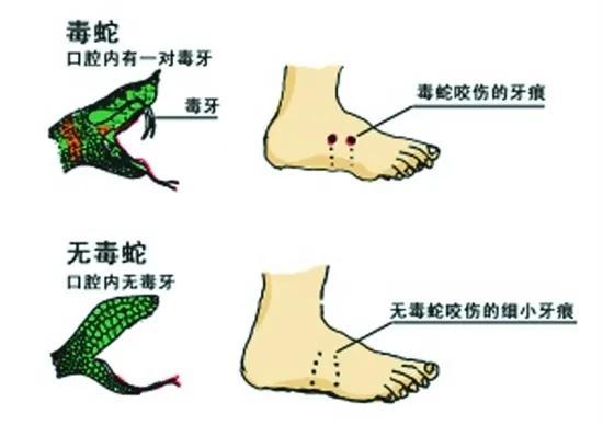 三亚被蛇咬伤致死女子伤口曝光 家属质疑医院误诊延误治疗